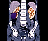 Renal cancer, CT scan