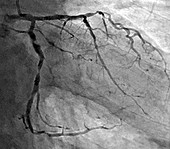 Coronary artery stenosis, coronarography scan