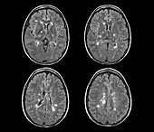 Multiple sclerosis, MRI scans
