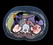 Pyelonephritis, axial CT scan