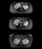 Polycystic kidney disease, MRI scans