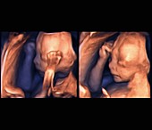 Foetus at 21 weeks, 3D ultrasound scans