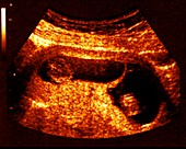 Twin foetuses at 9 weeks, ultrasound scan