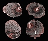 Recurrent glioma brain tumour, 3D MRI scans