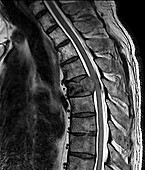 Secondary bone cancer in the spine, MRI scan