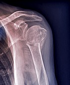 Broken upper arm bone, X-ray