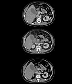 Gallbladder inflammation, axial CT scans