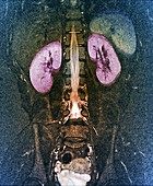 Kidneys and lumbar spinal cord, MRI scan