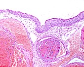 Masson's tumour, light micrograph