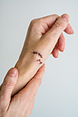 Suture after laceration