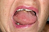 Angioedema of the tongue