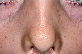 Allergic crease on nose in hay fever