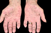 Latex allergy skin rash