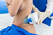 CoolSculpting, cryolipolysis session