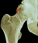 Hip osteoarthritis, coloured X-ray