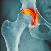 Hip arthritis, X-ray