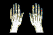 Hand arthritis, X-ray