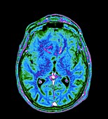 Meningioma brain tumour, MRI