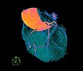 Normal heart, 3D CT scan