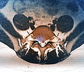 Herniated disk in sciatica, MRI