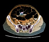 Colon cancer, CT scan