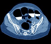 Colon cancer, CT scan