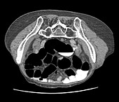 Colon cancer, CT scan