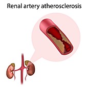 Renal artery atherosclerosis, illustration
