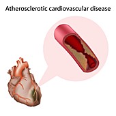 Atherosclerotic cardiovascular disease, illustration