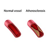 Atherosclerosis and normal blood vessel, illustration