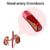 Renal artery thrombosis, illustration
