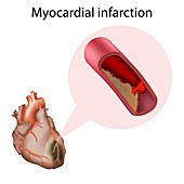 Myocardial infarction, illustration