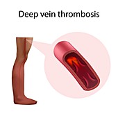 Deep vein thrombosis, illustration