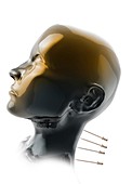 Acupuncture in human neck, illustration