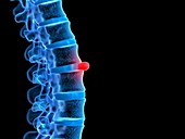 Prolapsed spinal disc, illustration