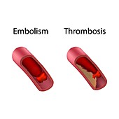 Embolism and thrombosis, illustration