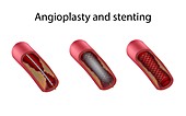 Stages of angioplasty and stenting, illustration