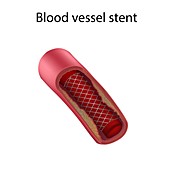 Blood vessel stent, illustration