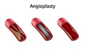 Stages of balloon angioplasty, illustration