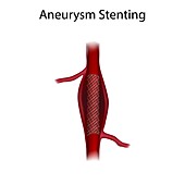 Aneurysm repair with stenting, illustration