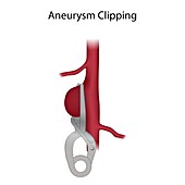 Aneurysm clipping, illustration