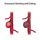 Aneurysm stenting and coiling, illustration