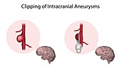 Clipping of intracranial aneurysms, illustration