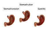 Gastritis, stomach ulcer and stomach erosion, illustration