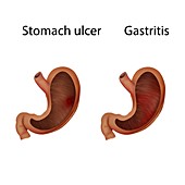 Gastritis and stomach ulcer, illustration