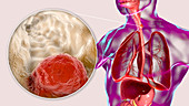 Oesophageal cancer, composite illustration