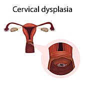 Cervical dysplasia, illustration