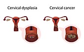 Cervical dysplasia and cervical cancer, illustration