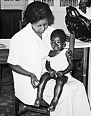Child with kwashiorkor in Ghana
