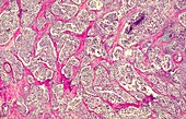 Ductal carcinoma in a human mammary gland,light micrograph